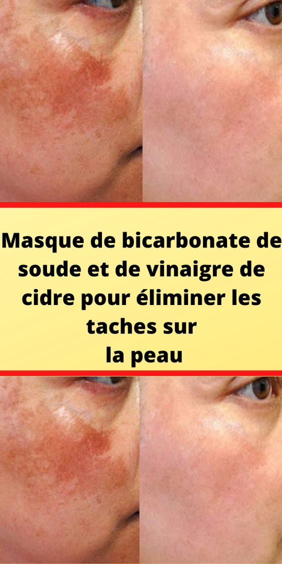 Masque de bicarbonate de soude et de vinaigre de cidre pour éliminer les taches sur la peau - haustiersos