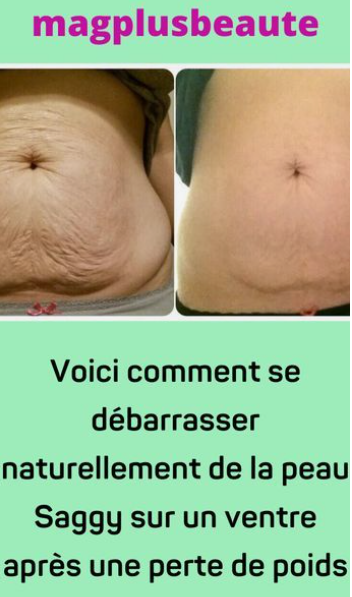 Voici comment se débarrasser naturellement de la peau Saggy sur un ventre après une perte de poids !!!