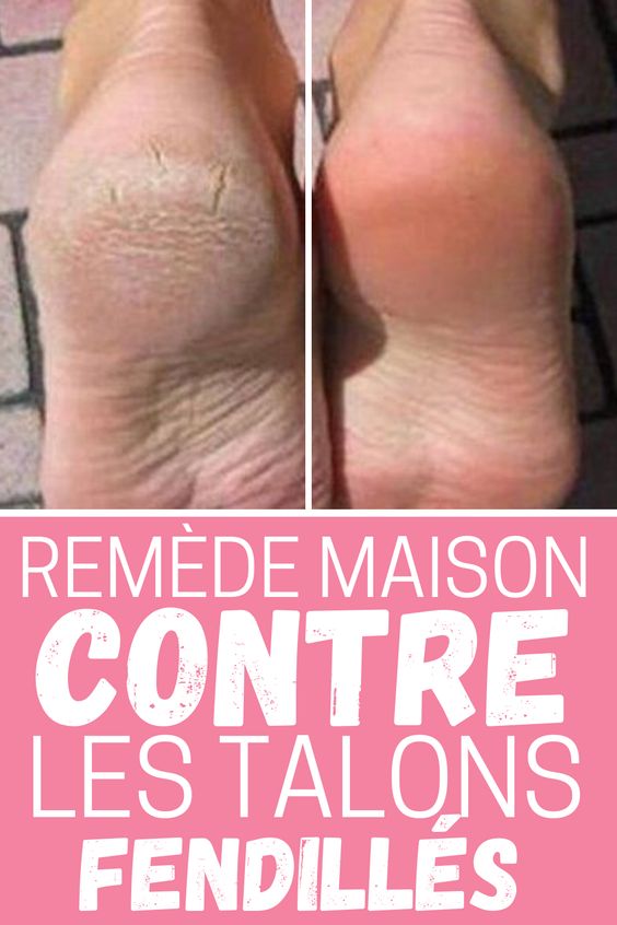 Remède miracle contre les talons secs et fissurés