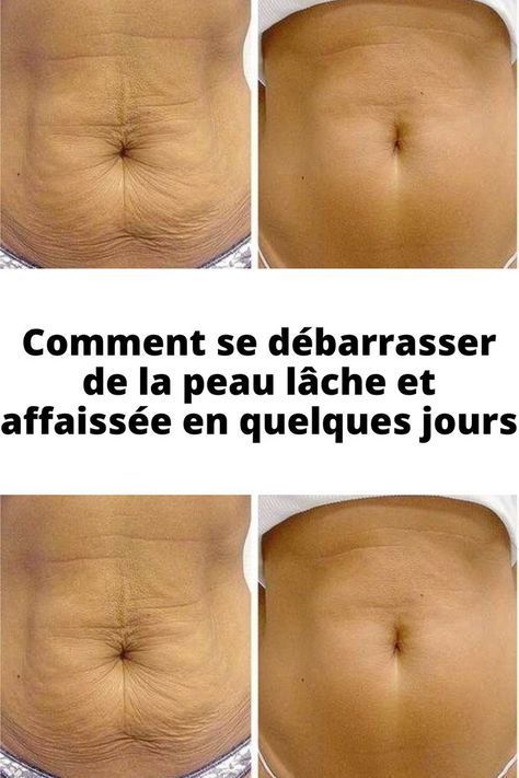 Comment se débarrasser de la peau lâche et affaissée en quelques jours