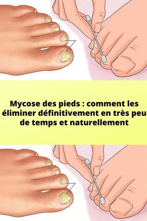 Mycose des pieds : comment les éliminer définitivement en très peu de temps et naturellement