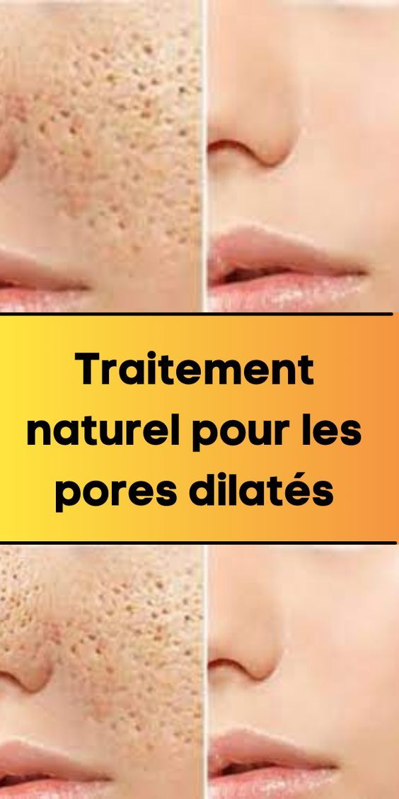 Traitement naturel pour les pores dilatés