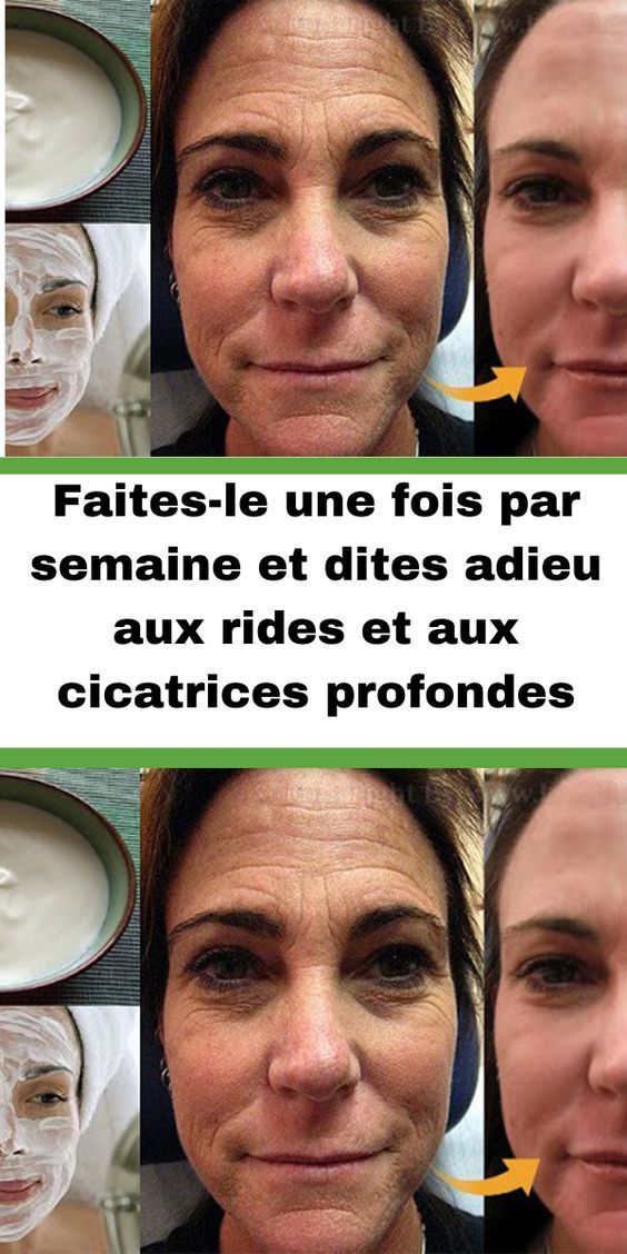 Faites-le une fois par semaine et dites adieu aux rides et aux cicatrices profondes