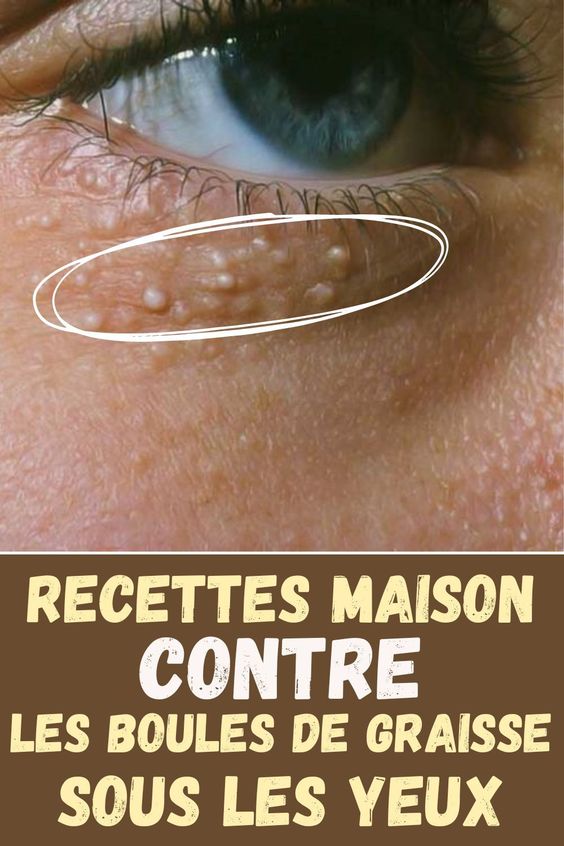 Recettes maison pour traiter les petites boules de graisse sous les yeux