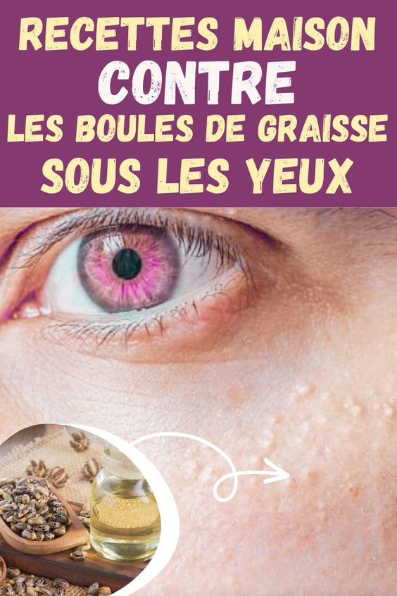 Recettes maison pour traiter les petites boules de graisse sous les yeux