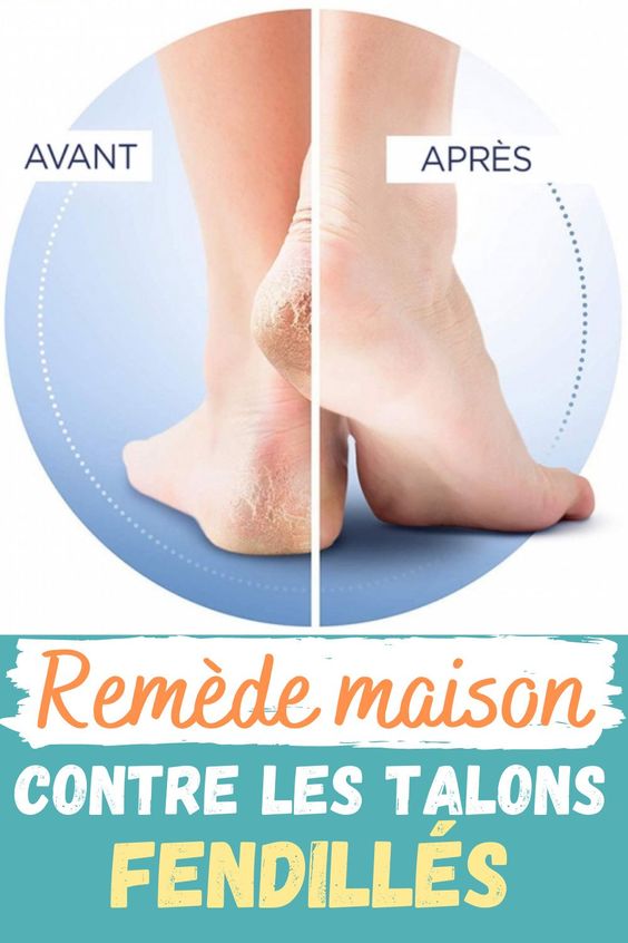 Remède maison contre les talons secs et déshydratés