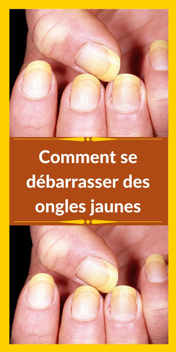 Comment se débarrasser des ongles jaunes