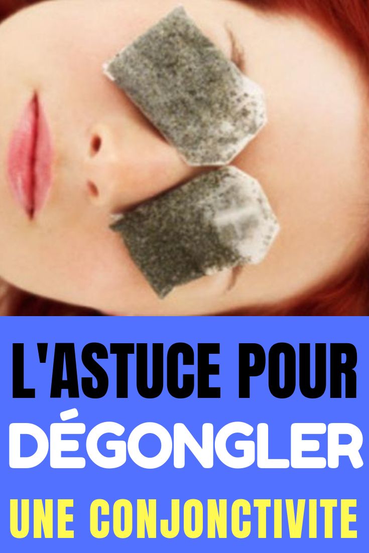 L'Astuce Idéale Pour Dégonfler Une Conjonctivite Naturellement.