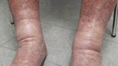 brûlure sous les pieds