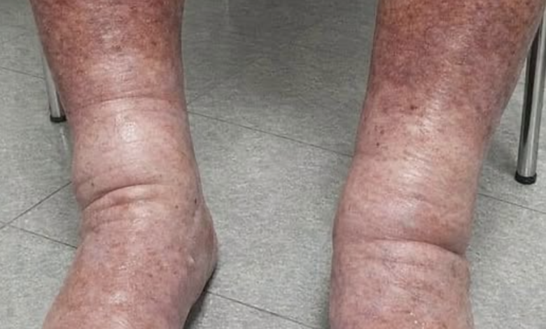brûlure sous les pieds