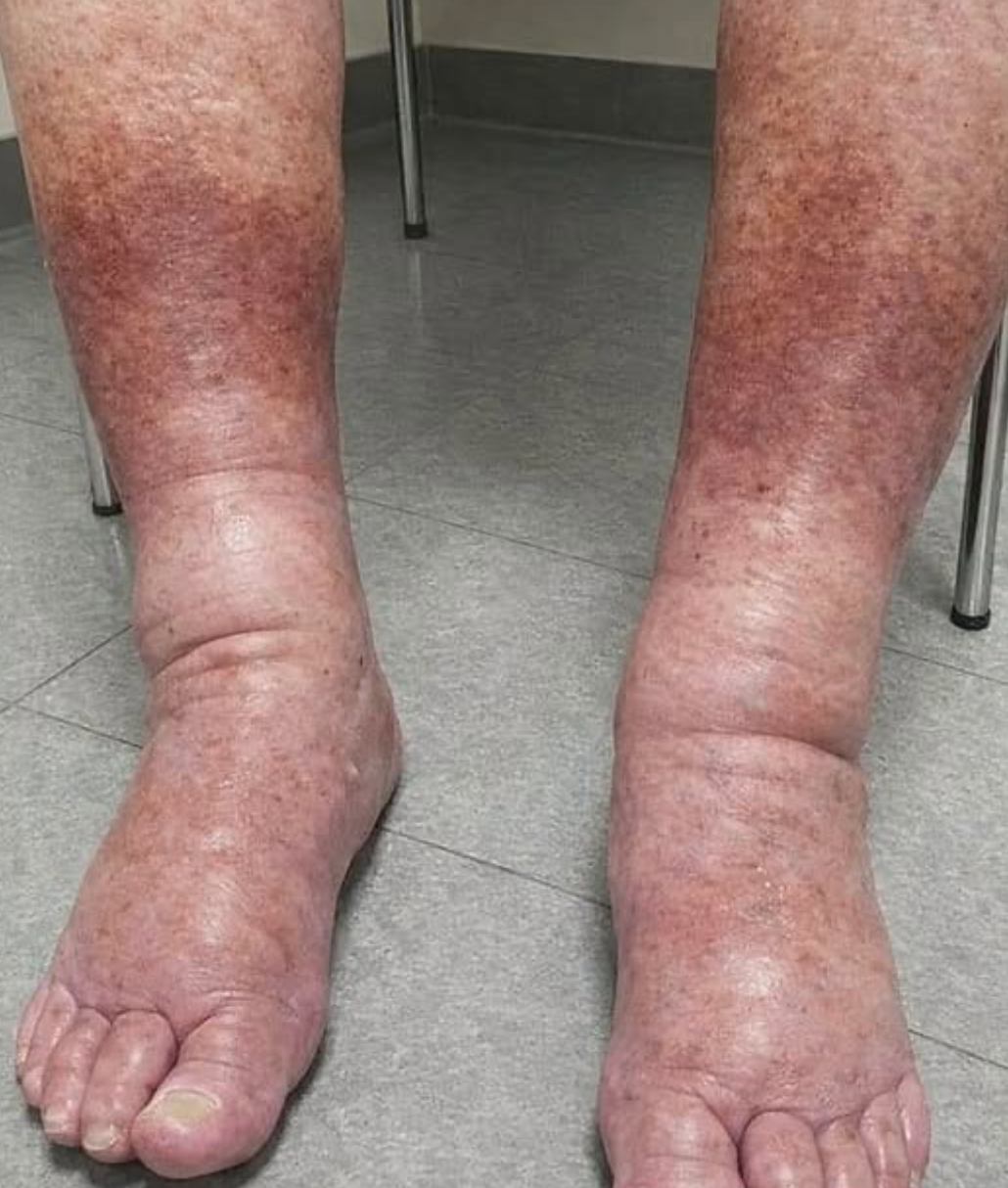 brûlure sous les pieds